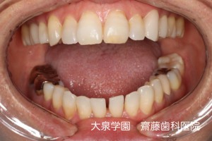 銀歯→白い歯（e.max）への交換｜齋藤歯科医院 [2013年10月27日]
