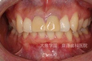 emax Anterior teeth
