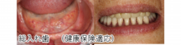 denture.png